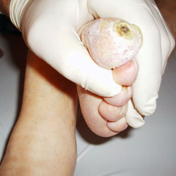 Podologia em Pés Diabéticos em Santos