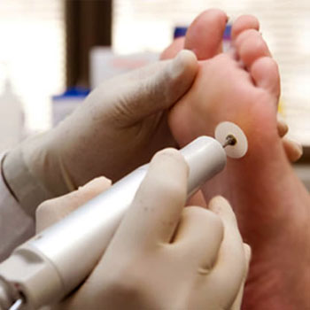 Tratamento para Calos nos Pés em Santos