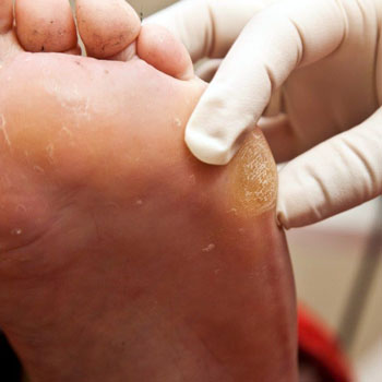 Tratamento para Calos nos Pés em Santos