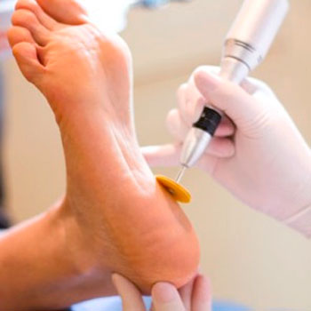 Tratamento para Calosidades nos Pés em Santos