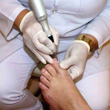 Tratamento de Micose nos Pés em Santos