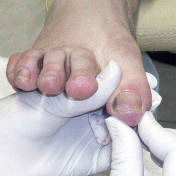 Tratamento de Micose nos Pés em Santos