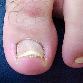 Tratamento de Micose nos Pés em Santos