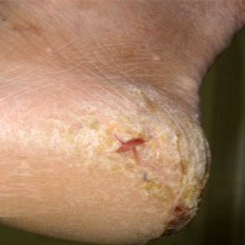 Tratamento de Micose nos Pés em Santos