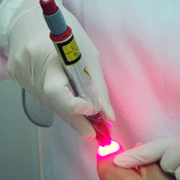 Tratamento de Micose nos Pés em Santos