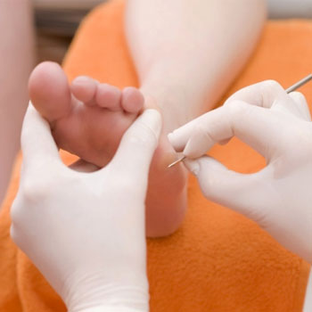 Tratamento de Pés Diabéticos em Santos