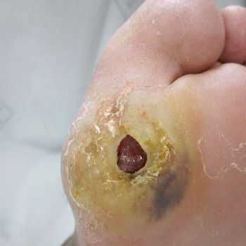 Tratamento de Pés Diabéticos em Santos