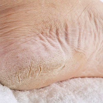 Tratamento de Pés com Rachaduras em Santos