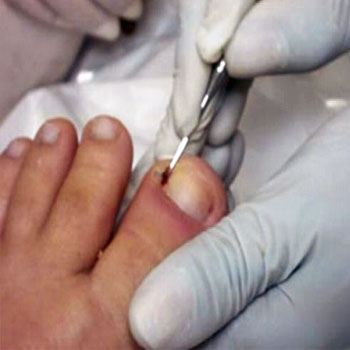 Tratamento de Unhas Encravadas e Infeccionadas em Santos