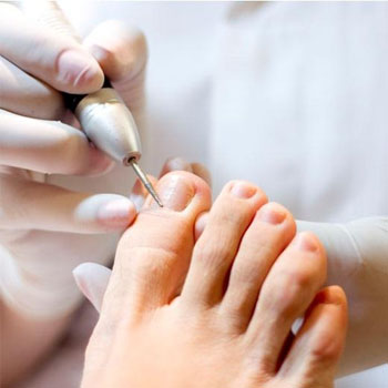 Tratamento de Unhas Encravadas e Infeccionadas em Santos